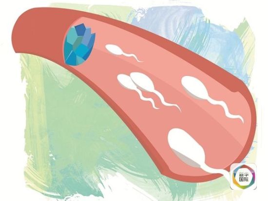 “输精管胶”阻拦精子示意图。 “输精管胶”阻拦精子示意图。