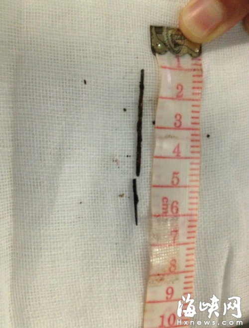 小娟体内取出的针长约5厘米，已经锈蚀