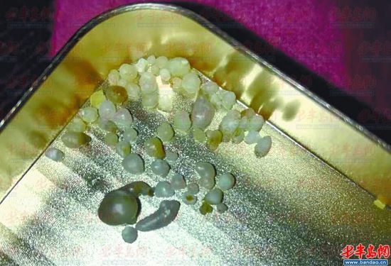 郭先生在海蛎子中吃出的珍珠。