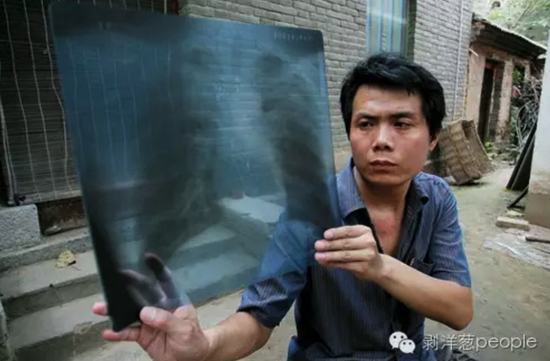 郑州新密市一座老屋院子里，张海超拿着自己的X光片，他被多家医院诊断为尘肺。