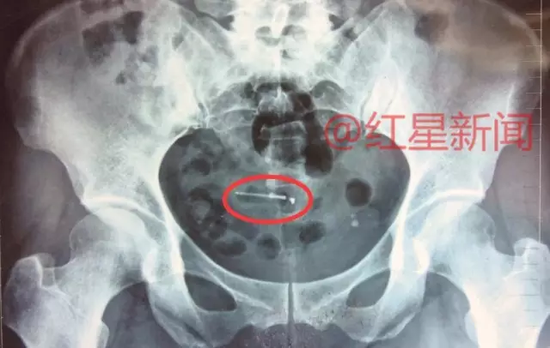 残留在滕优霞体内的节育环残片
