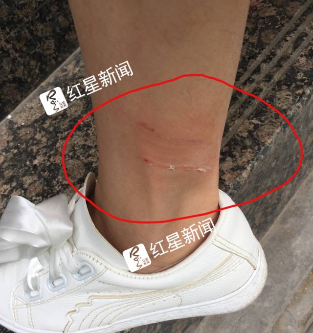  ▲被狗咬后的印痕 受访者供图