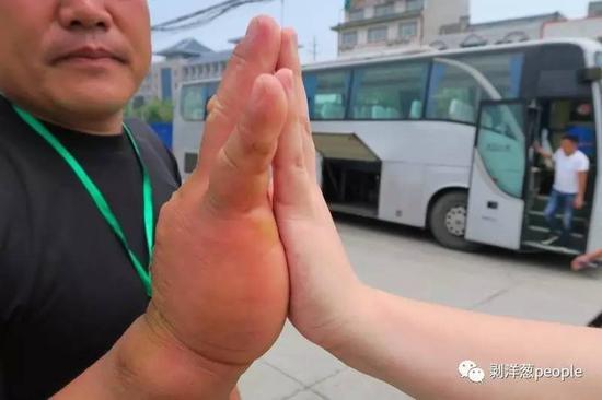 张龙祥的手和普通人的手对比。新京报记者韩雪枫 摄