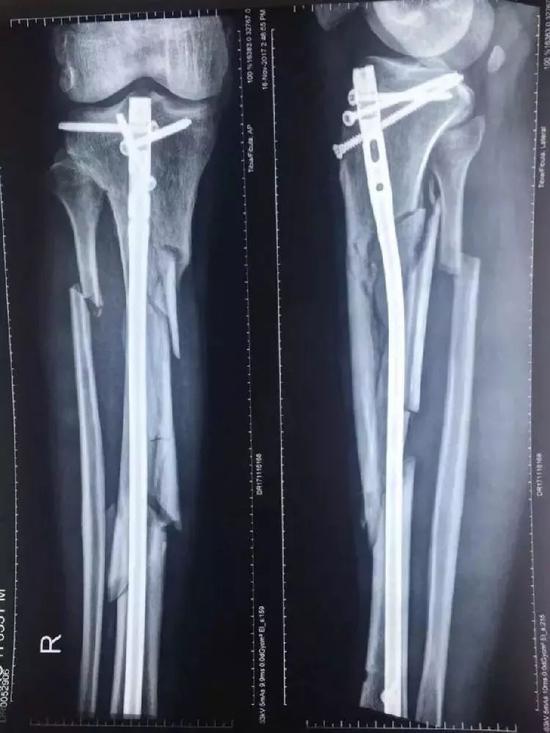 ▲张毅的右小腿骨粉碎性骨折。 图片来源：新京报
